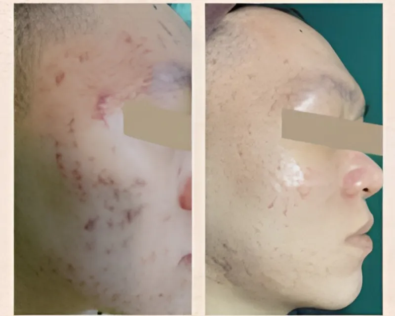 Before After 1