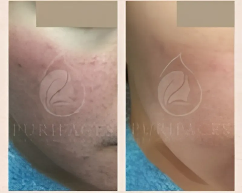 Before After 2