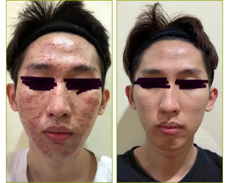 Before After 1