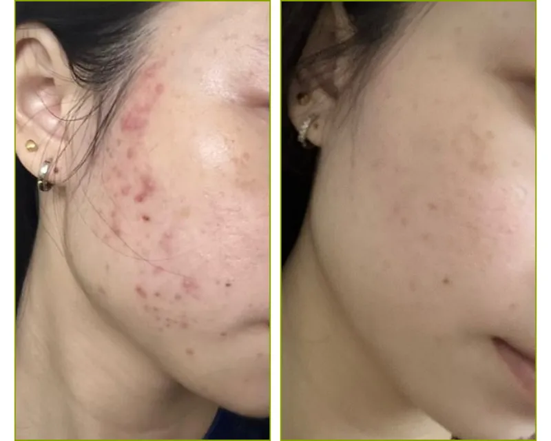 Before After 2