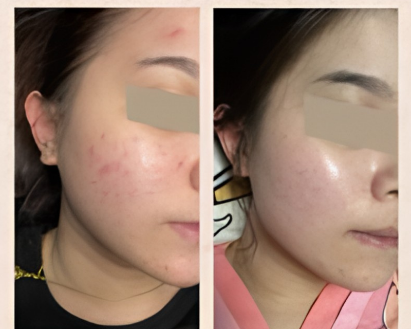 Before After 1