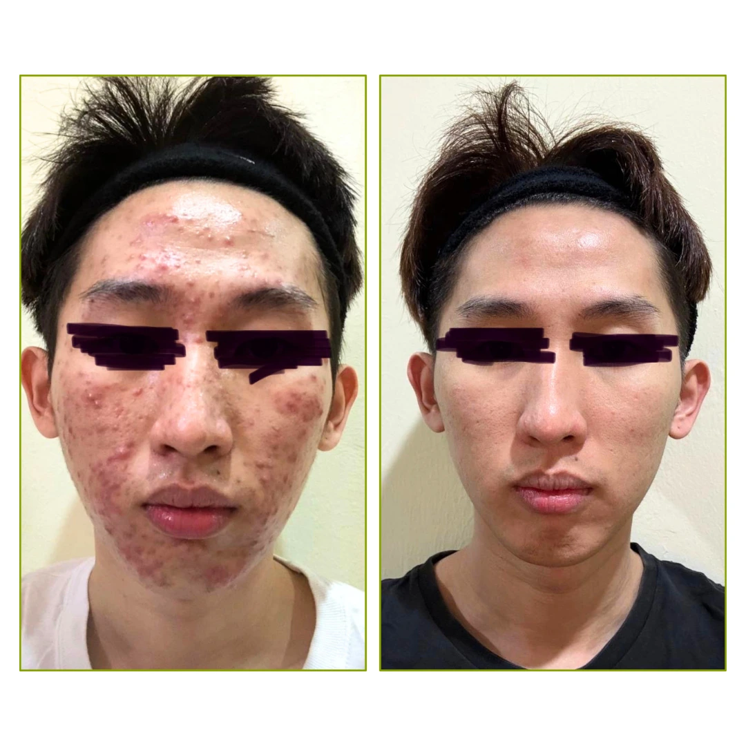Purifaces customer before and after result, image 12