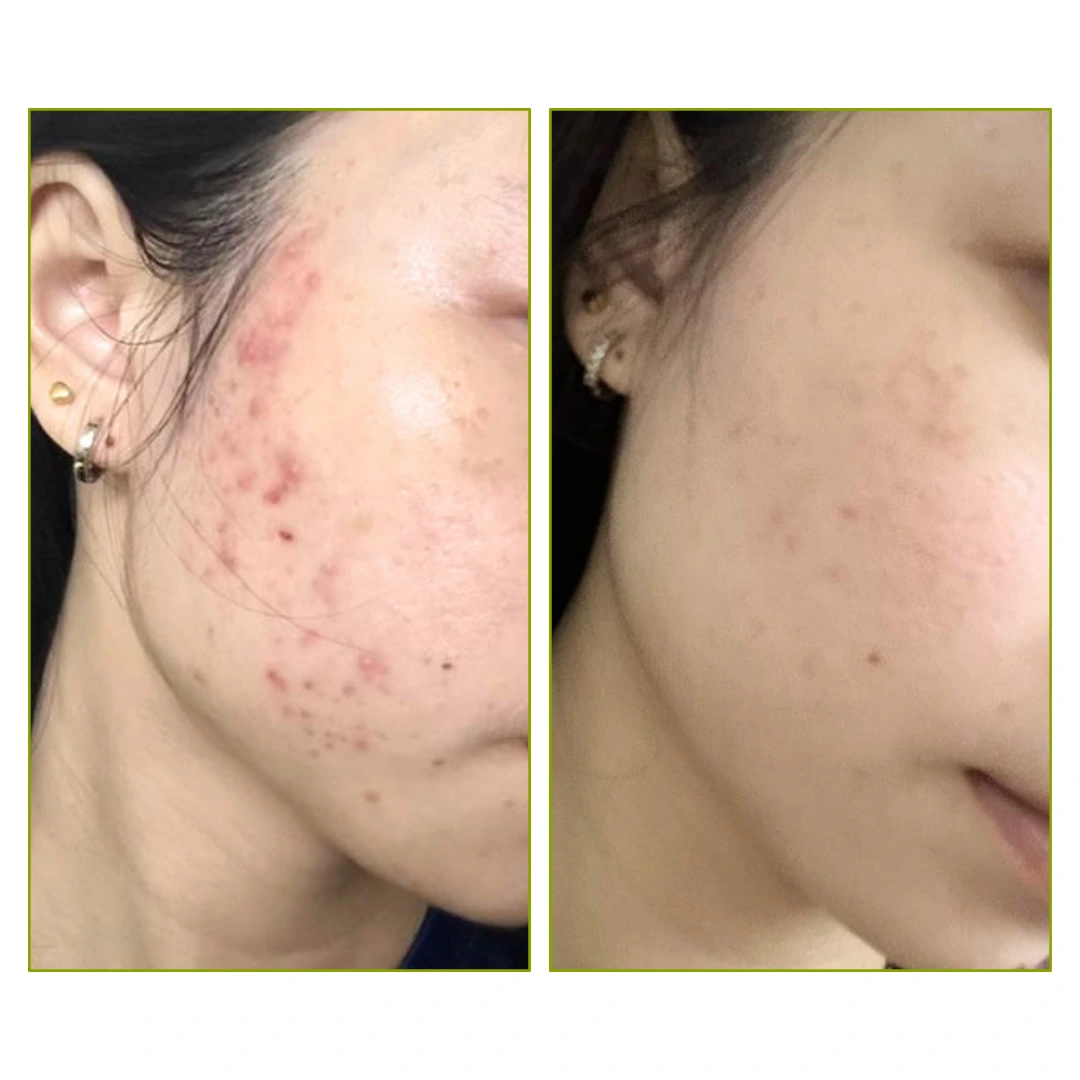 Purifaces customer before and after result, image 9