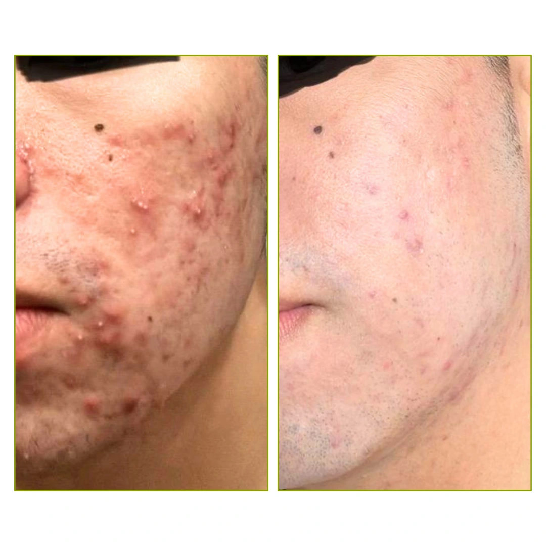 Purifaces customer before and after result, image 8