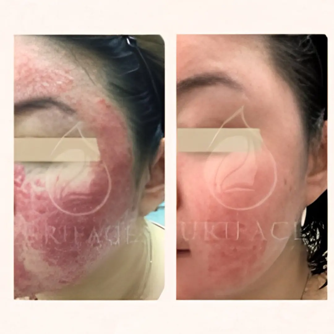 Purifaces customer before and after result, image 10
